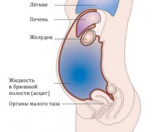 Асцит