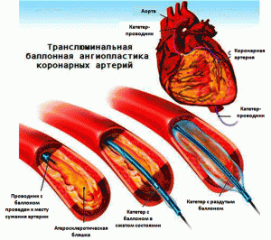 Коронарная балонная ангиоплатика