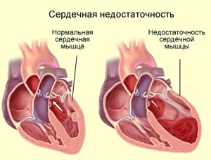 Сердечная недостаточность