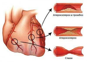 Стенокардия напряжения - общая картина