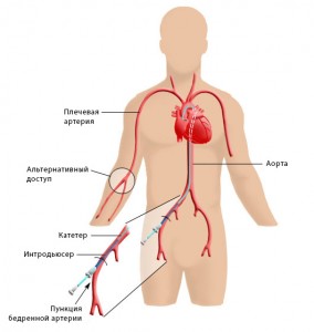 Ангиография