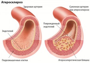 Атеросклероз сосудов
