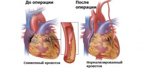 Шунтирование сосудов сердца