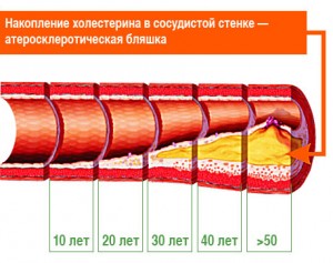 Что такое атеросклероз