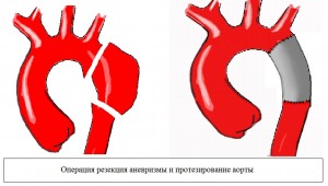 Хирургическое лечение недуга
