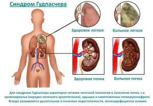 Этиология развития недуга