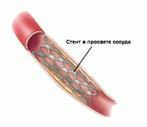 Как лечится аневризма