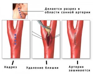 Хирургическое лечение 