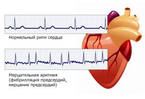 фото виды аритмии сердца