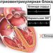 атриовентрикулярные-блокады-02
