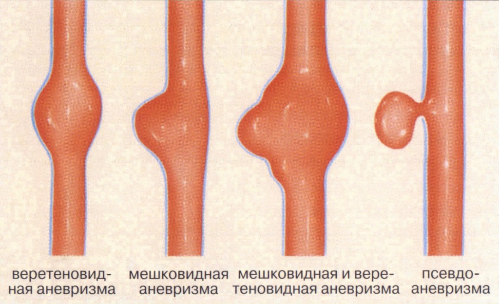 виды аневризм