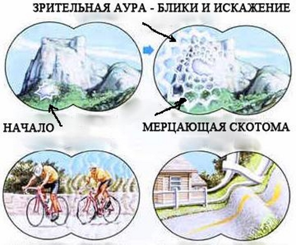 Зрительная Аура 