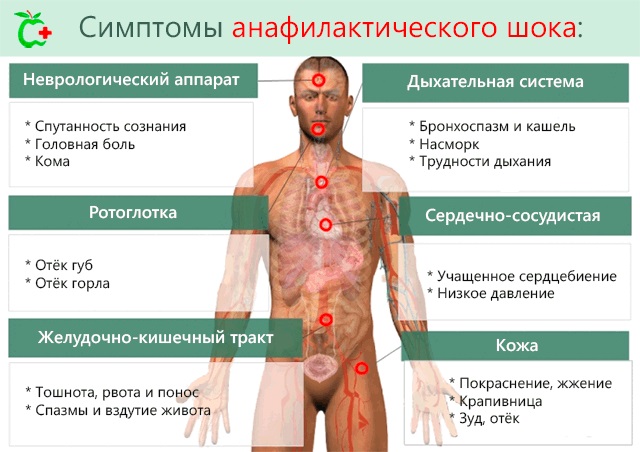 как определить анафилактический шок