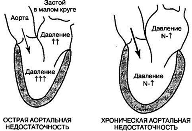 Аортальная недостаточность острая и хроническая