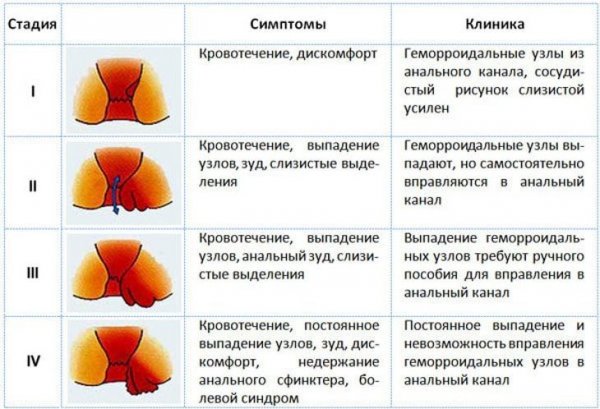 Симптомы наружного геморроя