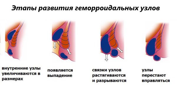стадии геморроя